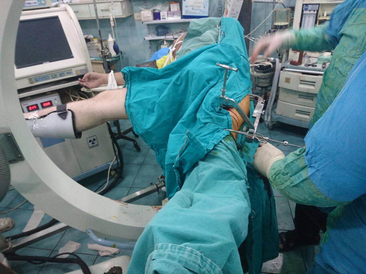 توريد مواد وأجهزة زراعة العظام إلى ثلاث مستشفيات في محافظة حلب
